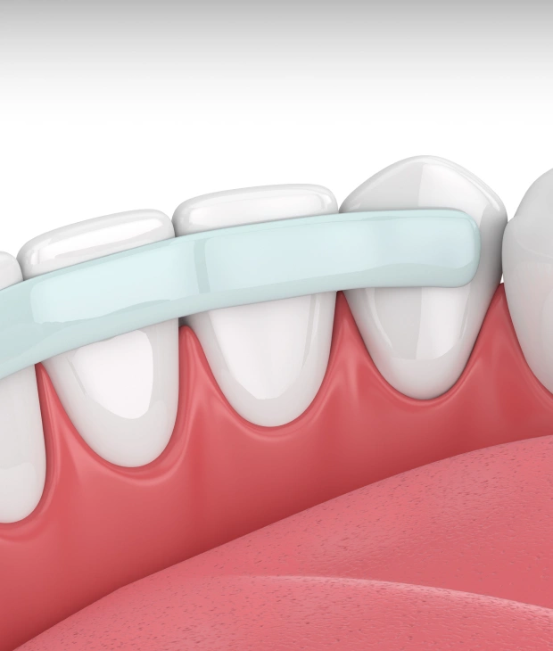 Illustration of dental bonding treatment on front teeth
