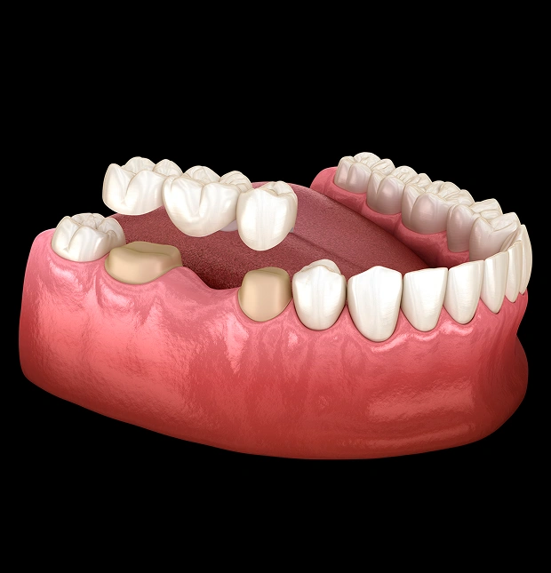 Illustration of dental bridges