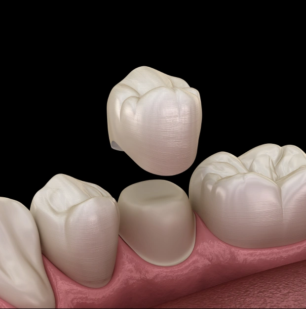 Illustration of dental crowns