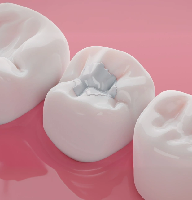 Illustration of dental fillings