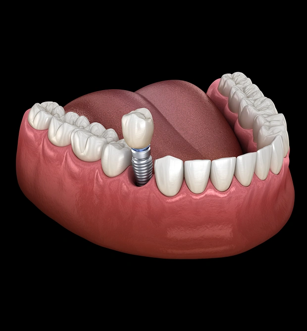 Dental implant restoration model