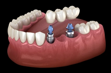 Illustration of an implant supported dental bridge