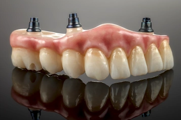 Implant supported denture restoration model
