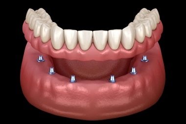 Illustration of implant supported dentures