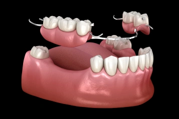 Partial denture model displaying replacement teeth