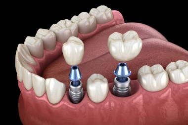 Illustration of single tooth dental implants
