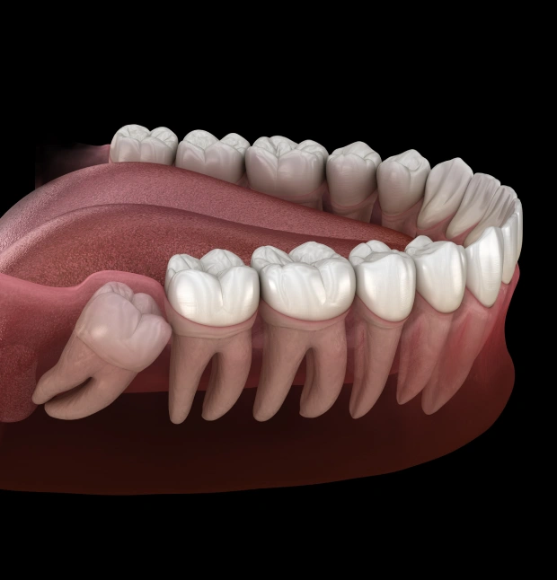 Illustration of wisdom tooth extraction treatment